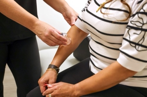 Acupuncture